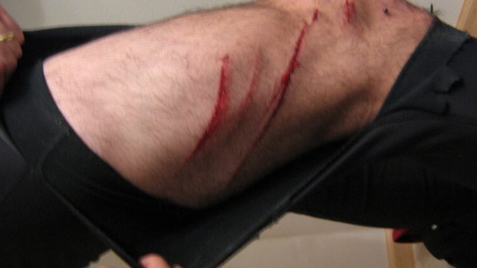 lower leg injury