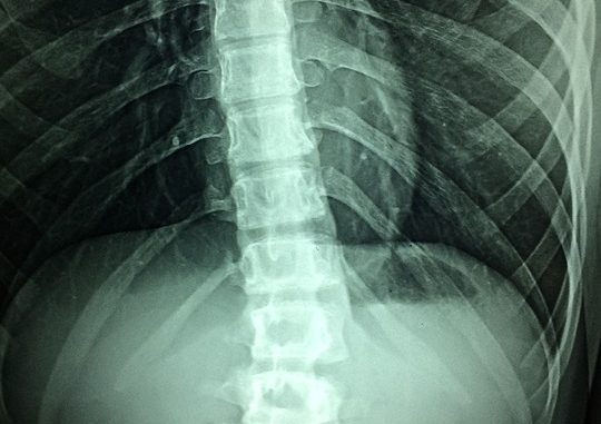 x-rays-1715903_960_720